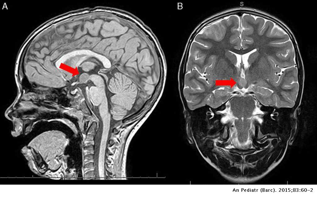 Hypothalamic Dysfunction Hypothalamic Dysfunction